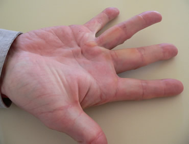 Dupuytren's contracture on ring finger