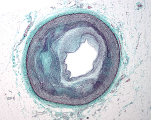 Cross section of an artery partially blocked by atherosclerosis