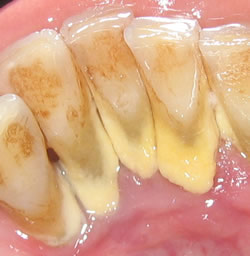 Heavy calculus / tartar build up on the base of these teeth, also brown staining
