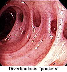 colon with diverticulosis