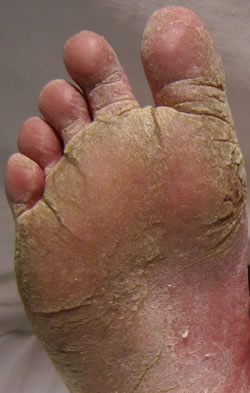 severe fungal infection of foot